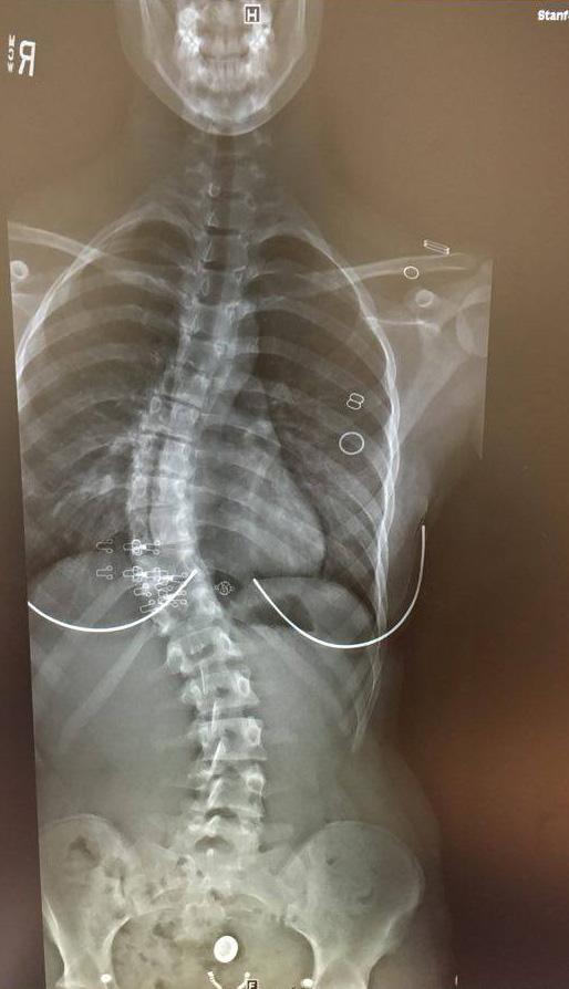 Around the bend: straightening out scoliosis